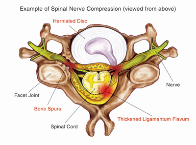Spinal Stenosis - Neurosurgery